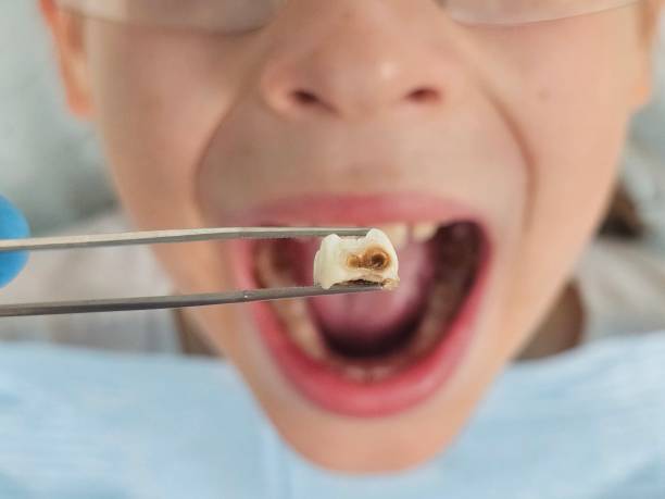 Best Emergency Tooth Extraction in Buckeye, AZ